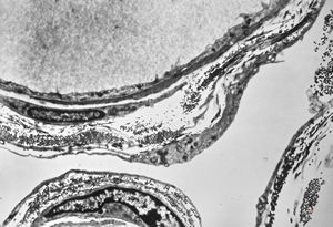 M,6y. | the wall of an arachnoid cyst M,6y. | the wall of an arachnoid cyst